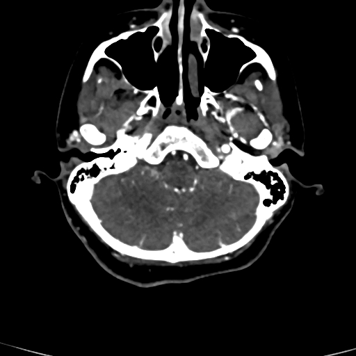 Cerebral arteriovenous malformation (Radiopaedia 73830-84645 Axial C+ delayed 78).jpg