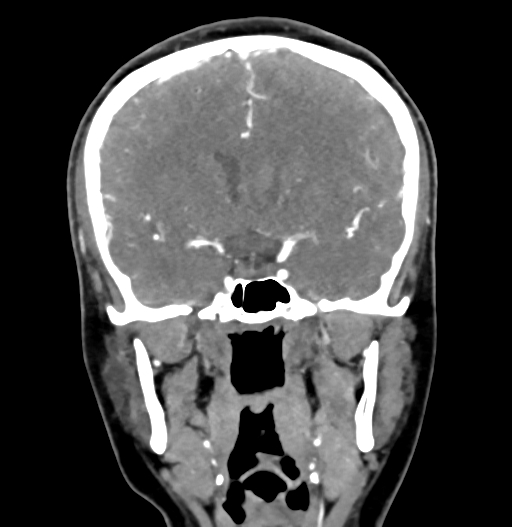 Cerebral arteriovenous malformation (Radiopaedia 73830-84645 C 44).jpg