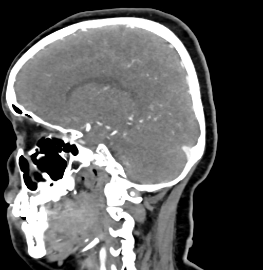 Cerebral arteriovenous malformation (Radiopaedia 73830-84645 D 38).jpg