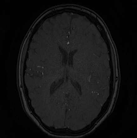 Cerebral arteriovenous malformation (Radiopaedia 74411-85654 Axial MRA 91).jpg