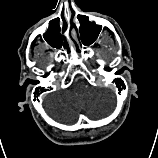 Cerebral arteriovenous malformation (Radiopaedia 78188-90746 Axial C+ delayed 29).jpg