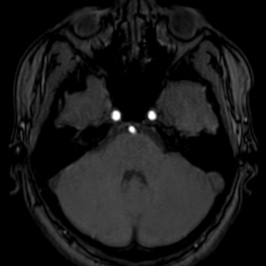 Cerebral arteriovenous malformation at posterior body of corpus callosum (Radiopaedia 74111-84925 Axial MRA 46).jpg