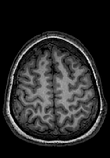 Cerebral arteriovenous malformation at posterior body of corpus callosum (Radiopaedia 74111-84925 Axial T1 45).jpg