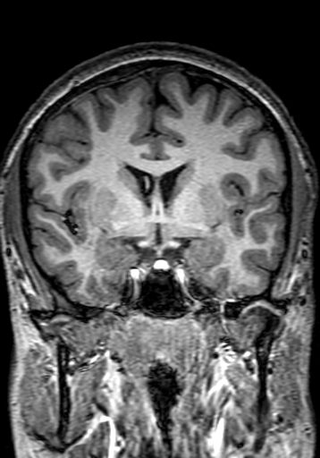 File:Cerebral arteriovenous malformation at posterior body of corpus callosum (Radiopaedia 74111-84925 Coronal T1 138).jpg