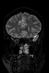 Cerebral arteriovenous malformation at posterior body of corpus callosum (Radiopaedia 74111-84925 Coronal T2 44).jpg