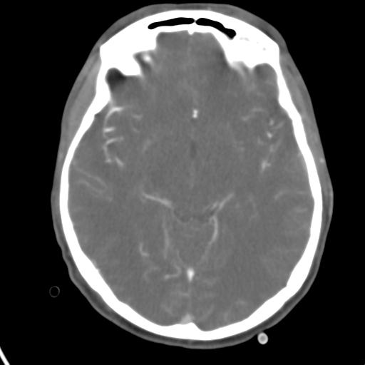 Cerebral arteriovenous malformation with hemorrhage (Radiopaedia 28773-29073 A 31).jpg