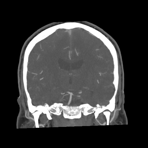 Cerebral arteriovenous malformation with lobar hemorrhage (Radiopaedia 35598-57216 C 49).jpg
