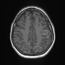 Cerebral cavernous venous malformation (Radiopaedia 70008-80021 Axial T1 60).jpg