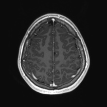 Cerebral cavernous venous malformation (Radiopaedia 70008-80021 Axial T1 C+ 78).jpg