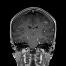 File:Cerebral cavernous venous malformation (Radiopaedia 70008-80021 Coronal T1 C+ 29).jpg
