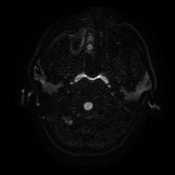 Cerebral cavernous venous malformation (Zabramski type II) (Radiopaedia 85511-101198 Axial DWI 36).jpg