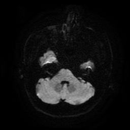 Cerebral cavernous venous malformation (Zabramski type II) (Radiopaedia 85511-101198 Axial DWI 42).jpg