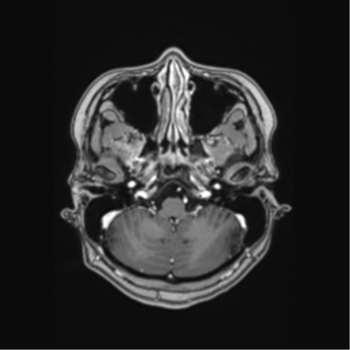 Cerebral cavernous venous malformations (Radiopaedia 48117-52946 Axial T1 C+ 6).png