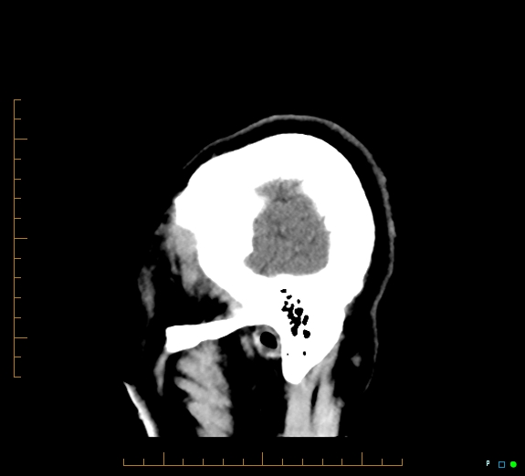 Cerebral fat embolism (Radiopaedia 85521-101220 B 49).jpg