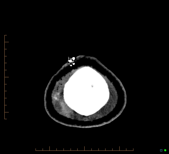 Cerebral fat embolism (Radiopaedia 85521-101224 Axial non-contrast 51).jpg
