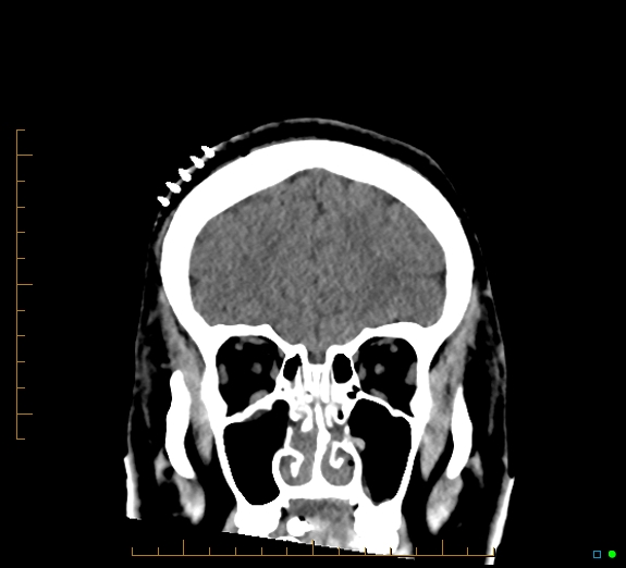 Cerebral fat embolism (Radiopaedia 85521-101224 Coronal non-contrast 16).jpg
