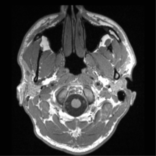 File:Cerebral hemorrhagic contusions- temporal evolution (Radiopaedia 40224-42757 Axial T1 6).png