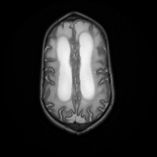 File:Cerebral manifestations of mucopolysaccharidosis type I (Radiopaedia 59171-66487 Axial T2 17).jpg