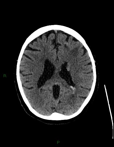 File:Cerebral metastases - ependymal and parenchymal (Radiopaedia 79877-93131 Axial non-contrast 47).jpg