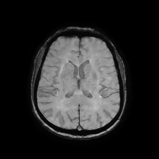 File:Cerebral metastases - melanoma (Radiopaedia 80972-94522 Axial SWI 58).jpg