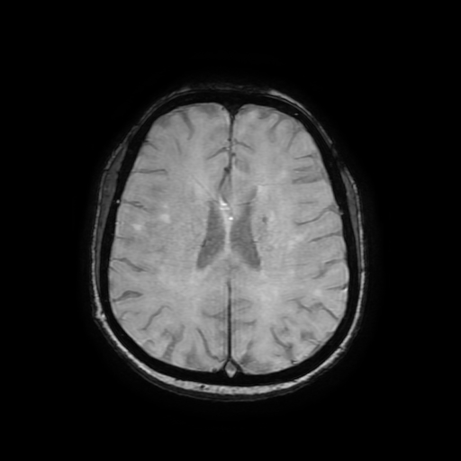 Cerebral metastases - melanoma (Radiopaedia 80972-94522 Axial SWI 64).jpg