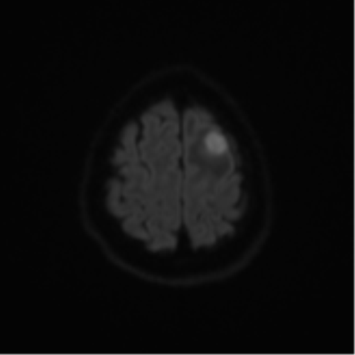 Cerebral metastases mimicking abscesses (Radiopaedia 45841-50131 Axial DWI 53).png