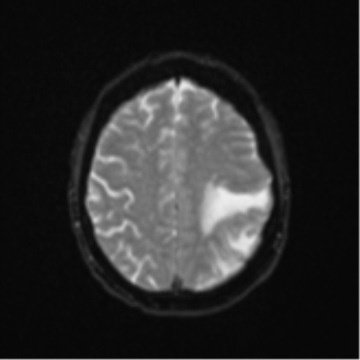 Cerebral metastasis (Radiopaedia 46744-51248 Axial DWI 21).png