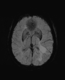 File:Cerebral metastasis (Radiopaedia 46744-51248 Axial SWI 17).png