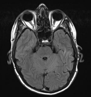 File:Cerebral metastasis - melanoma (Radiopaedia 54718-60954 Axial FLAIR 10).png