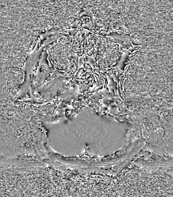 Cerebral metastasis to basal ganglia (Radiopaedia 81568-95413 Axial SWI phase 9).png