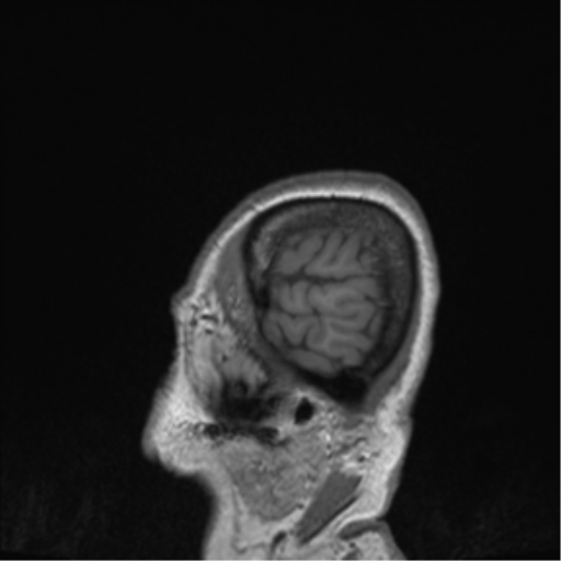 Cerebral metastasis to basal ganglia (Radiopaedia 81568-95413 Sagittal T1 2).png