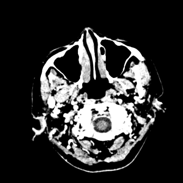 Cerebral ring enhancing lesions - cerebral metastases (Radiopaedia 44922-48818 B 16).jpg