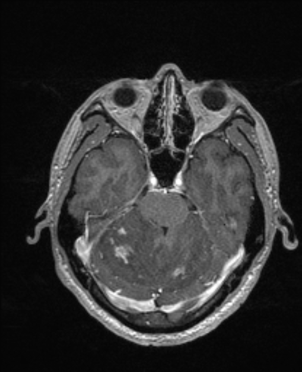 Cerebral toxoplasmosis (Radiopaedia 85779-101597 Axial T1 C+ 51).jpg