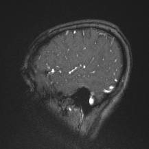 Cerebral venous infarction - hemorrhagic (Radiopaedia 81625-95505 Sagittal MRV 64).jpg