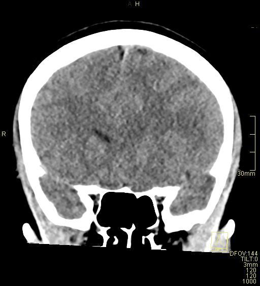 Cerebral venous sinus thrombosis (Radiopaedia 91329-108965 Coronal non-contrast 19).jpg