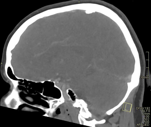Cerebral venous sinus thrombosis (Radiopaedia 91329-108965 Sagittal venogram 34).jpg