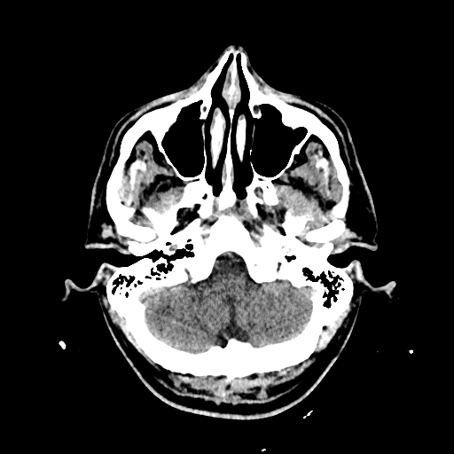 File:Cerebral venous thrombosis (CVT) (Radiopaedia 77524-89685 Axial non-contrast 7).jpg