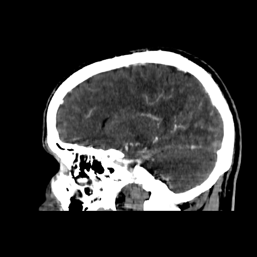 File:Cerebral venous thrombosis (CVT) (Radiopaedia 77524-89685 Sagittal CTV 16).jpg