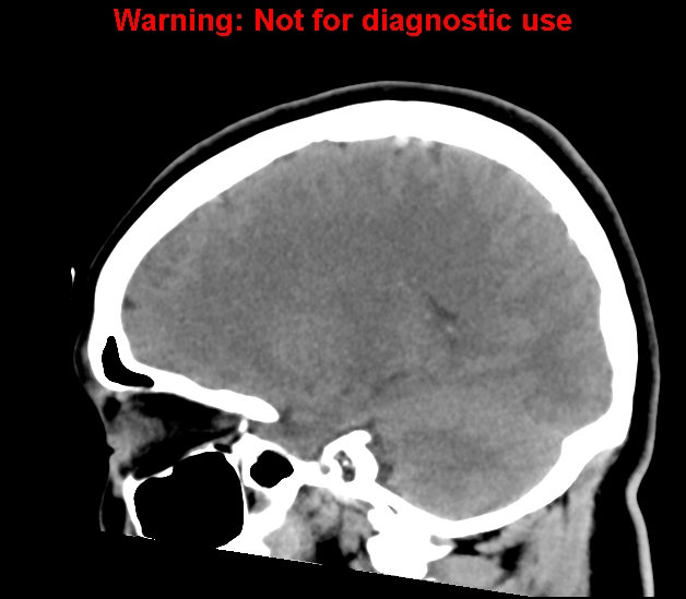 File:Cerebral venous thrombosis (Radiopaedia 37224-38992 B 12).jpg