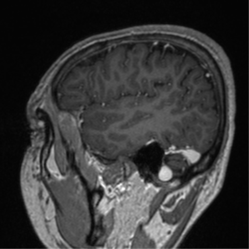 File:Cerebral venous thrombosis (Radiopaedia 38392-40469 Sagittal T1 C+ 21).png