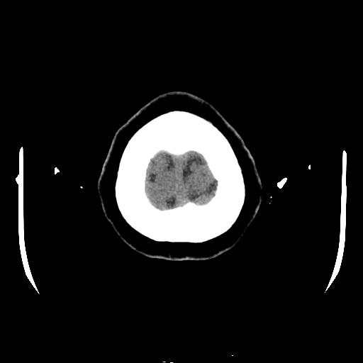 Cerebral venous thrombosis with venous hemorrhagic infarct (Radiopaedia 90354-107660 Axial non-contrast 49).jpg
