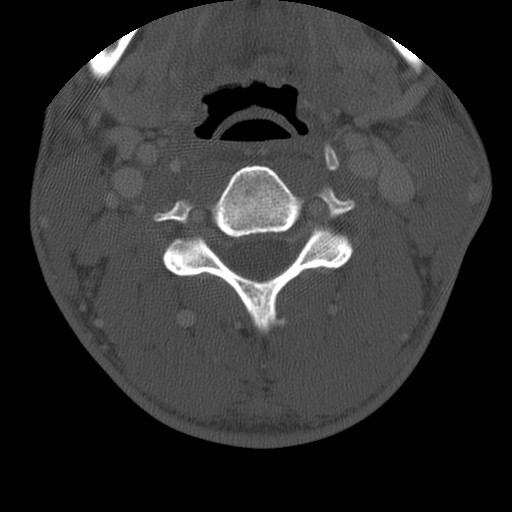 Cervical Pott disease (Radiopaedia 20374-20286 Axial bone window 71).jpg