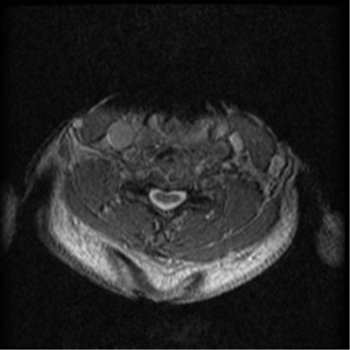 Cervical canal stenosis with cord compression (Radiopaedia 34114-35374 Axial Gradient Echo 38).png