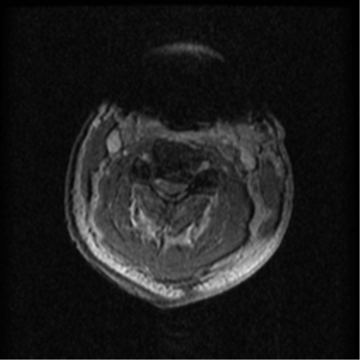 Cervical canal stenosis with cord compression (Radiopaedia 34114-35374 Axial Gradient Echo 64).png