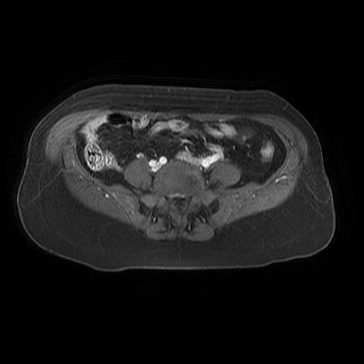 File:Cervical carcinoma (Radiopaedia 67644-77047 Axial T1 C+ fat sat 3).jpg