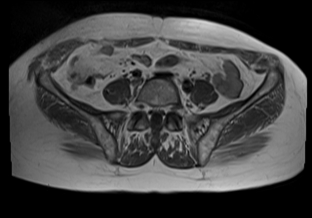 File:Cervical carcinoma (Radiopaedia 88312-104943 Axial T1 3).jpg