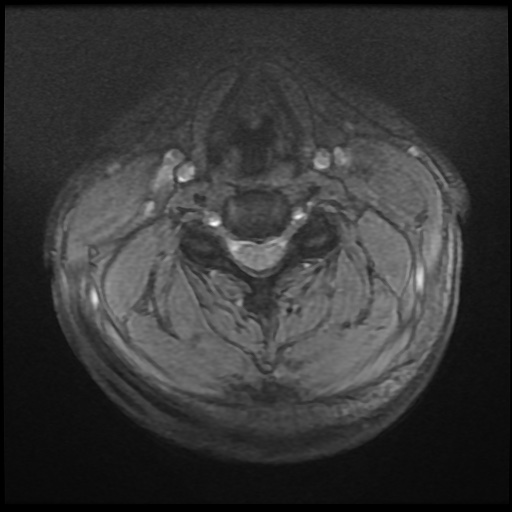 Cervical disc extrusion (Radiopaedia 59074-66364 F 18).jpg