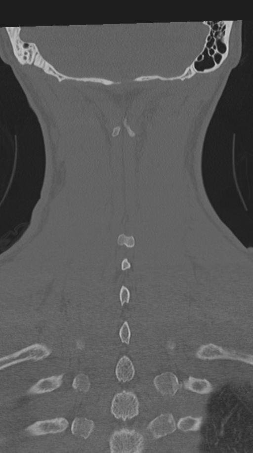 Cervical intercalary bone (Radiopaedia 35211-36748 Coronal bone window 64).png
