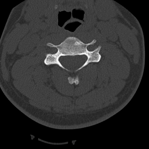 File:Cervical schwannoma (Radiopaedia 57979-64974 Axial bone window 23).png