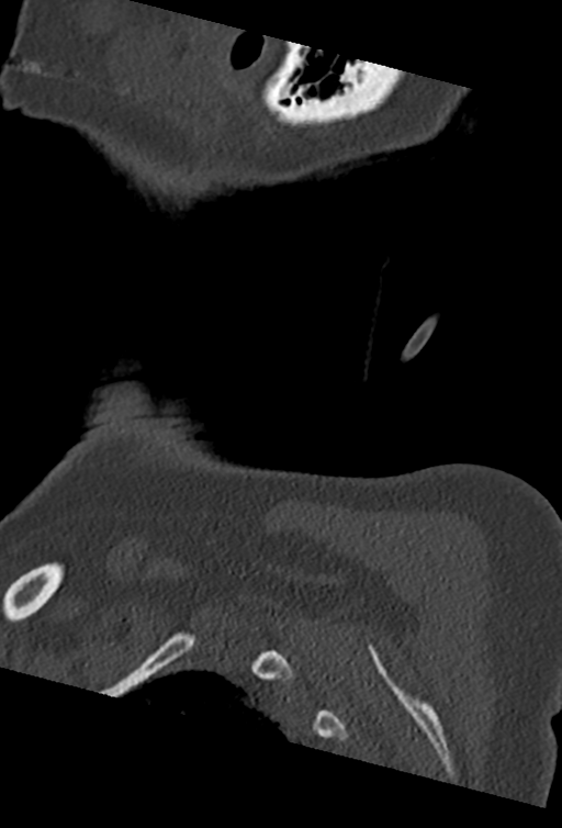 Cervical spine ACDF loosening (Radiopaedia 48998-54070 Sagittal bone window 83).png